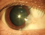 See more of isec international specialist eye centre on facebook. Pterygium, wedge shaped growth on the eye - ACS Eye ...