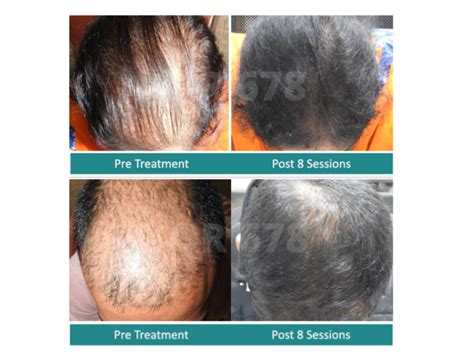 Top 48 Image Treatments For Womens Hair Loss Vn