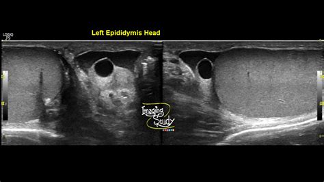 Case 24 Epididymal Cyst Imaging Study