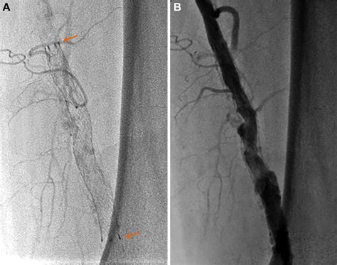Symptomatic Superficial Femoral Artery Pseudoaneurysm Due To Late Stent