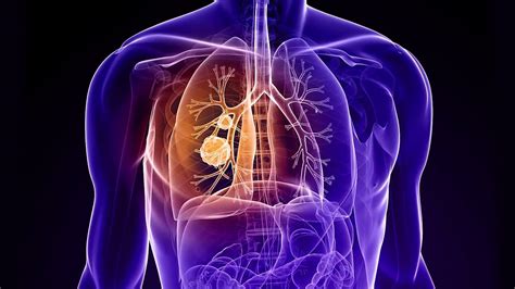 Lung Cancer Symptoms Causes And Treatment Video Dailymotion
