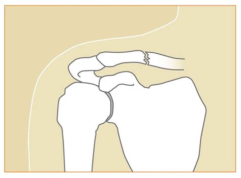 Types Of Shoulder Fractures And Shoulder Fracture Recovery Process
