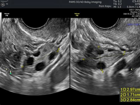 Fertility Scan Private One On One Pregnancy And Fertility Ultrasound