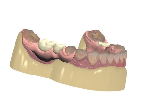 Impress3d Digital Valplast Partial Dentures For Dentists And Patients