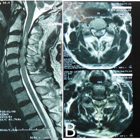 Mri Picture Showing Multilevel Cervical Stenosis Download Scientific