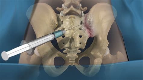 It comprises the developer and the purchasers and is responsible for. Sacroiliac Joint Dysfunction Test | Pain and Spine Clinics