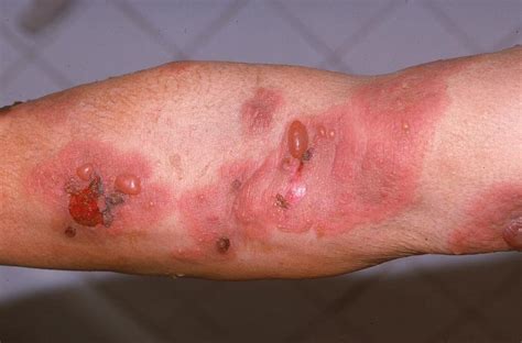 Precancerous skin lesions and skin cancer slideshow. Med Insight LT