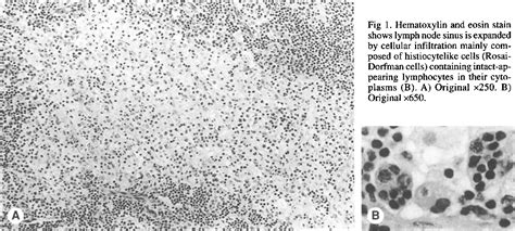 Figure 1 From Review Of Sinus Histiocytosis With Massive