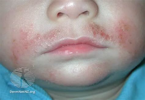 Atopic Dermatitis On The Face Treatment And Tips Myeczemateam