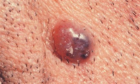 What Does Skin Cancer Look Like A Visual Guide To Warning Signs Allure