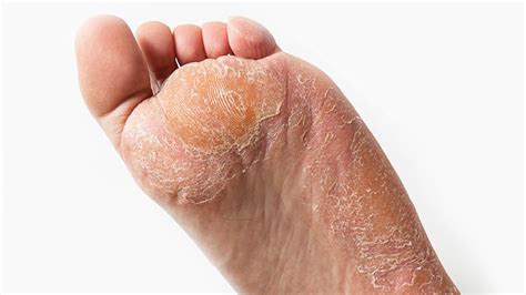 Dry Skin On Top Of Toes How To Remove Hard Skin Get Silky Soft Feet