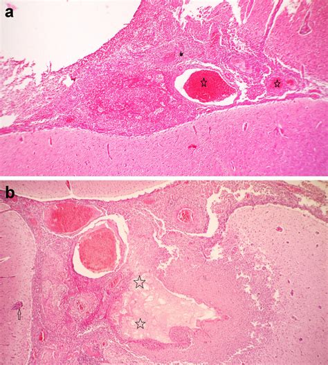 A Meningitis With The Penetration Of Inflammatory Cells Including