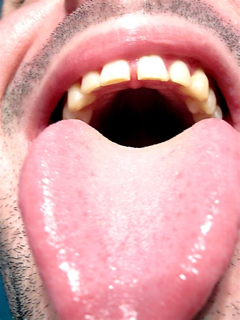 Tongue Discoloration Your Dental Health Resource