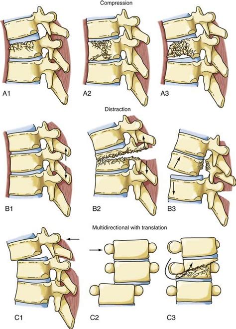 Diagnosis And Management Of Thoracic Spine Fractures Clinical Gate