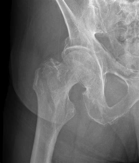 X Ray Depicting Stable Intertrochanteric Femur Fracture Aoota 31 A1