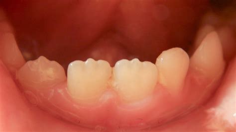 Jagged Teeth Causes Treatments And More Healthline