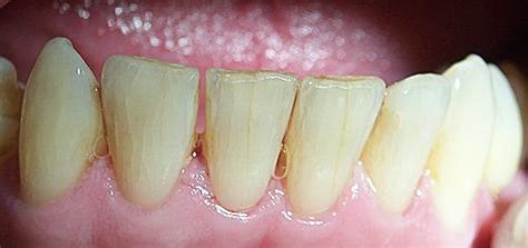 types  broken teeth   fix wilhite plano dentist