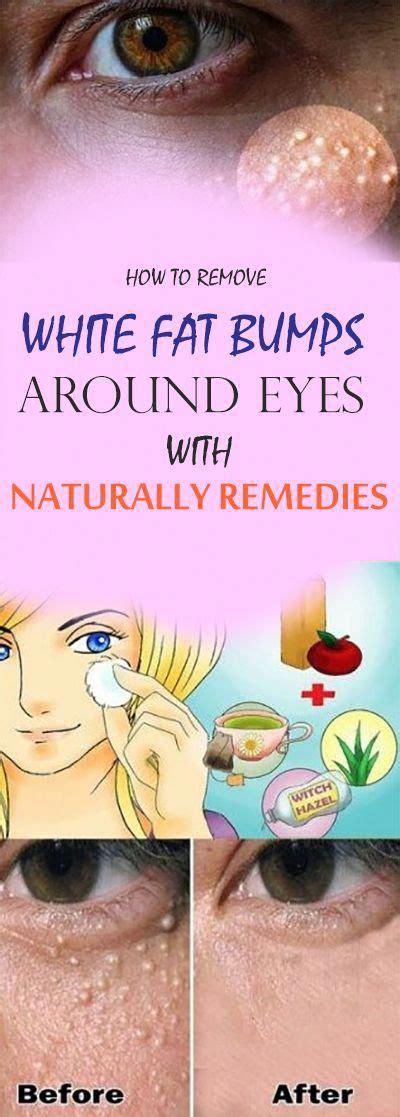 How To Get Rid Of White Fat Bumps Around Eyes Naturally Healthy Team