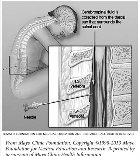 Spinal Tap Or Lumbar Puncture A Long Thin Needle Is Carefully Inserted