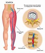 Pictures of Home Remedies For Trapped Nerve In Back
