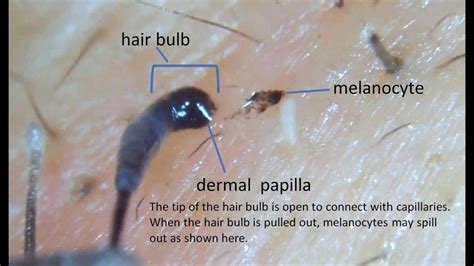 Top 48 Image Hair Follicle Pulled Out Vn