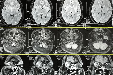 Pre Operative Mri A Multiple Acute Embolic Infarcts In The Bilateral