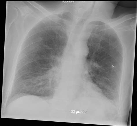 Bornholm Disease Chest X Ray Wikidoc