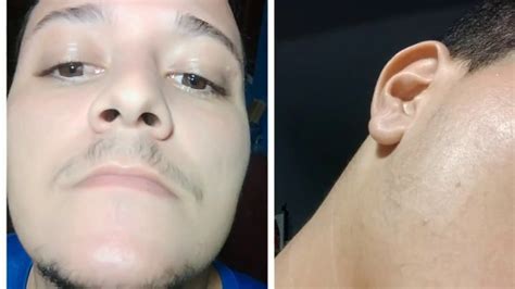 Minoxidil 1 MÊs De Uso Resultados Youtube