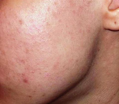 Diagnosis And Treatment Of Acne Aafp