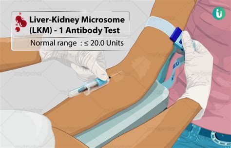 Liver Kidney Microsome Lkm 1 Antibody Procedure Purpose Results