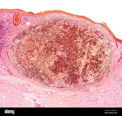 Skin Cancer Light Micrograph Of A Section Through A Malignant