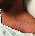 Typical maculopapular rash of Zika virus.* *Photograph courtesy of Dr ...