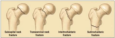 Three Main Types Of Hip Fractures Femoral Neck Fracture Subcapital