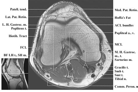 Knee Muscle Anatomy Axial Mri Mri Knee Anatomy Knee Sagittal Images