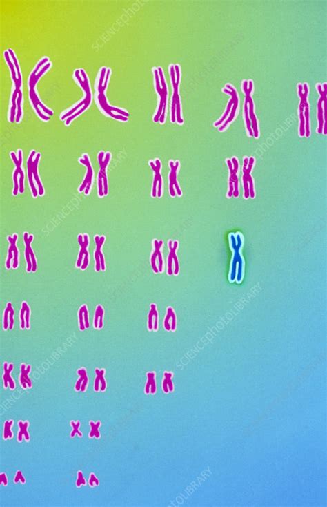 Karyotype Of Turner S Syndrome Stock Image M352 0023 Science