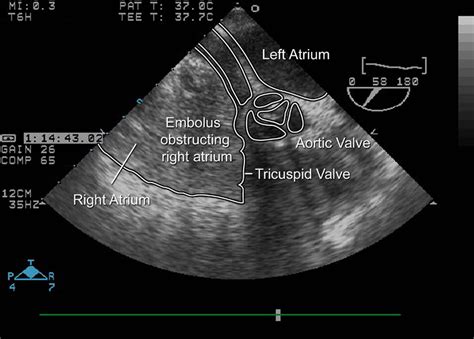 A B Midesophageal Transesophageal Echocardiogram Shows A Large