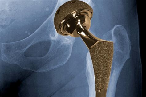 New Discovery Could Lead To Better Artificial Hips