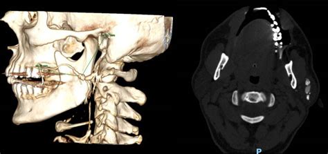 Computed Tomography Ct Of A Right Submandibular Gland Sialolith The