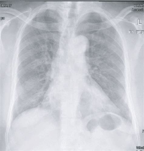 Chest X‐ray Demonstrating Patchy Ground Glass Opacity In The Lower Lung