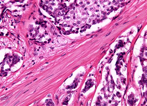 Lymph Node Metastatic Carcinoma At 20x Magnification Nikons Microscopyu