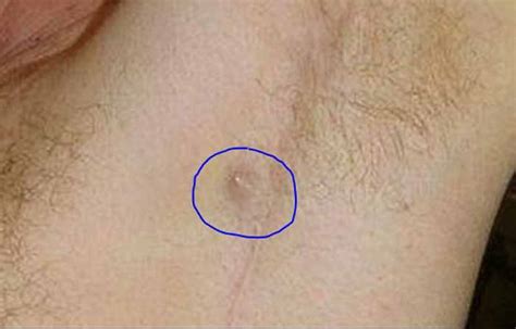 Ingrown Armpit Hair Lymph Node Pictures Lump How To Get Rid Home