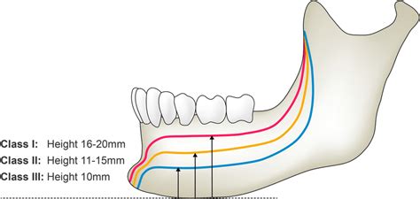 Luhr Classification Of The Edentulous Mandible According To The Degree