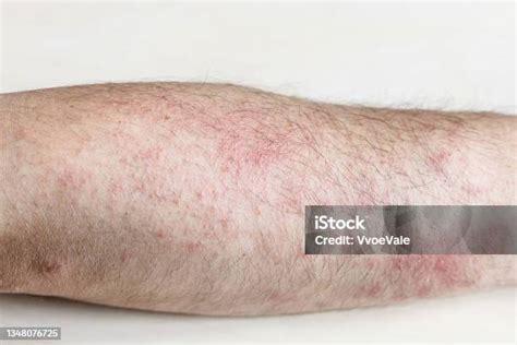 Rash On Outside Forearm Close Up Stock Photo Download Image Now 50