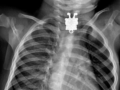 X Rays From Radiopaedia Show Objects In Strange Places
