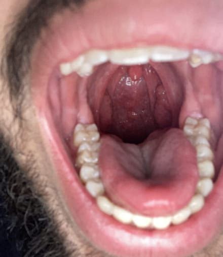Bultos en la garganta (indoloro) - Otorrinolaringología - CCM Salud