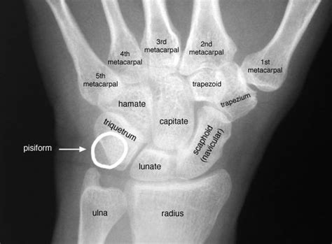 Top Photos In Wrist Joint X Ray