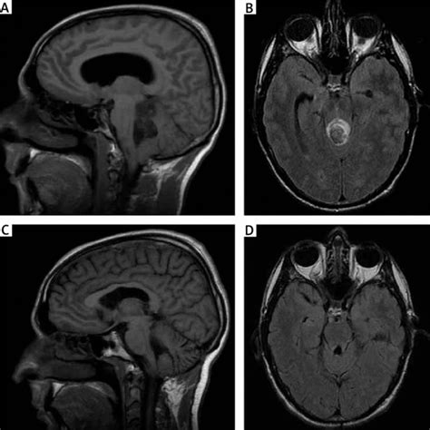 A B Preoperative Mri T1 Weighted Sagittal And T2 Weighted Axial