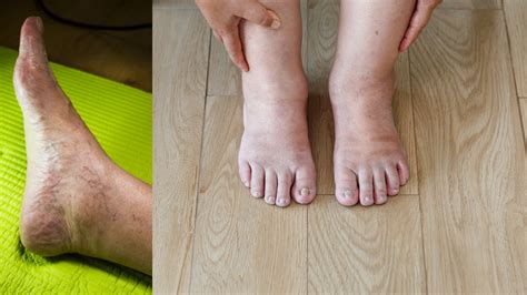 Swollen Ankle And Feet Symptoms Causes Treatment Symptom Clinic
