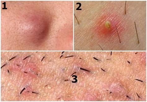 Other times you will just see a rash in the. Ingrown Hair Cyst: Removal & How to Get Rid, Pop, Treat ...