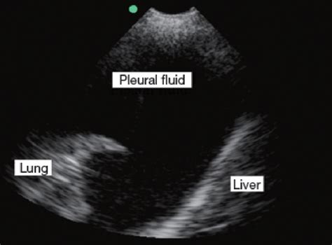 Wet Wacky Lungs A Quick Look At Pleural Effusions — Nuem Blog